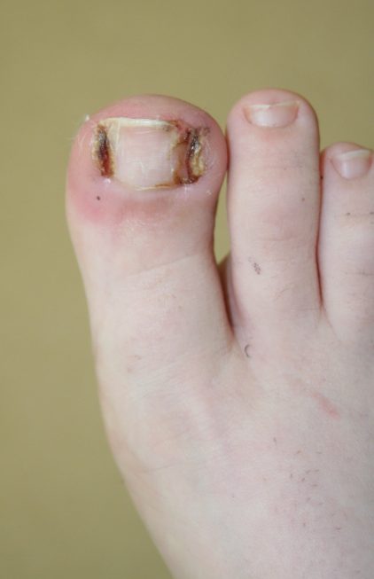 ongle incarné